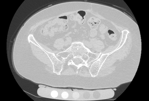 Quantitative CT