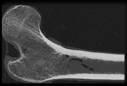 Calgary Bone Health Study