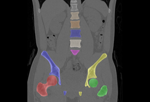 Opportunistic CT