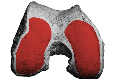 Knee ACL Injuries and OA