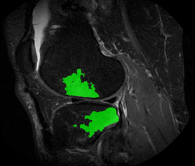 Using machine learning for feature detection and extraction from MRI