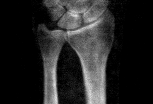 The Contribution of a Forearm DXA to an Osteoporosis Diagnosis