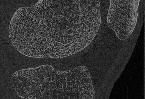 Improved image segmentation of bone by image filtering