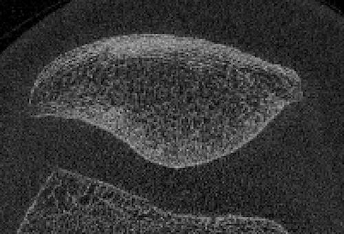 The Prevalence of Patellar Osteoarthritis Following ACL Injury