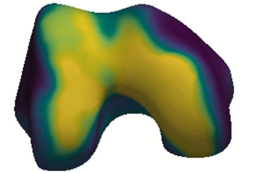 What are the longitudinal changes in subchondral bone thickness after ACL injury?